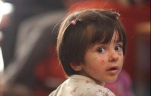 نذر خدمت به کودکان مبتلا به بیماری پروانه‌ای